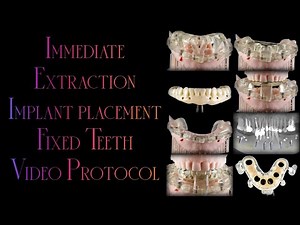 How to use Stackable Surgical Guides?