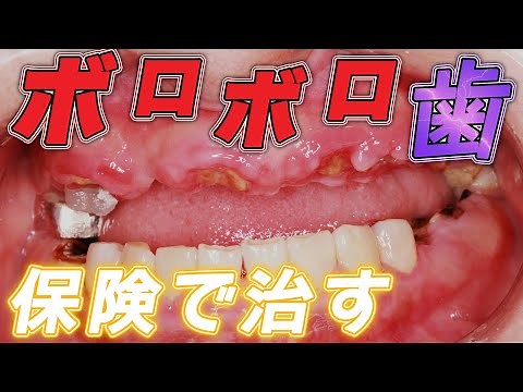 【歯がボロボロの方必見】ボロボロになった歯は保険治療で治せるのか