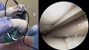 Complex Knee Bucket Handle Tear: Case Review, Single Portal Arthroscopy Demonstration