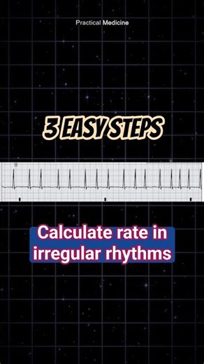 3 Easy Steps - Calculate rate in irregular rhythm ECGs #ECG #interpretation #AF #atrialfibrillation