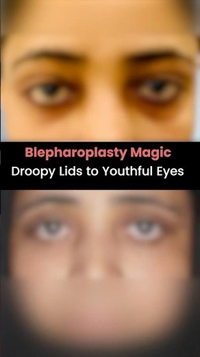 Blepharoplasty Magic Droopy Lids to Youthful Eyes | Eyelid Surgery Before After Result