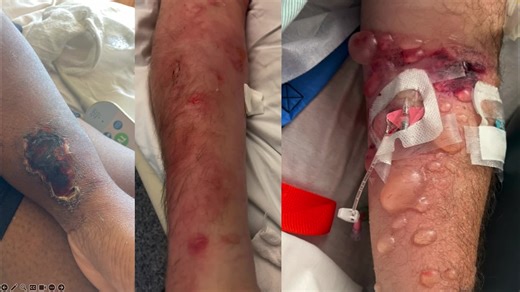 Understanding Vancomycin: Common Misconceptions