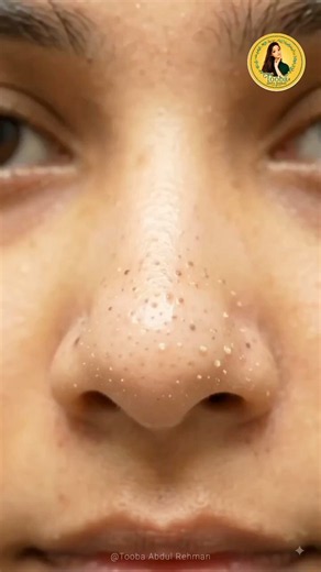 Remove Blackheads & Whiteheads Naturally | Easy Home Remedy for Clear & Smooth Skin #skincareshorts