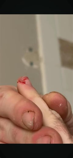 DIY shower rod turned into a pinky scare. Hubris 0. Tools 1.