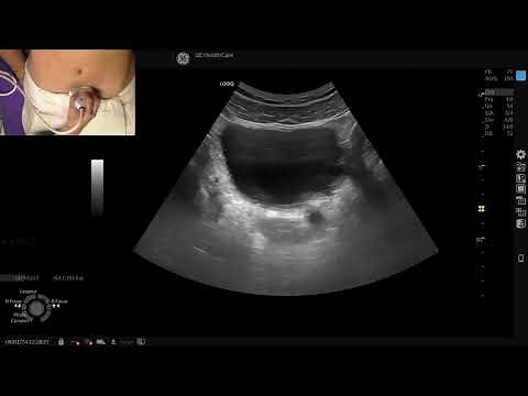 Apprenez à explorer les voies urinaires par échographie en médecine générale !