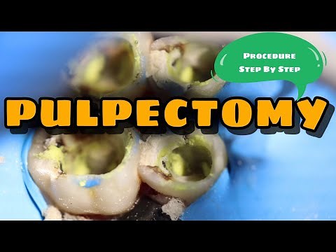 Pulpectomy | Procedure Step By Step | Kedo Square File