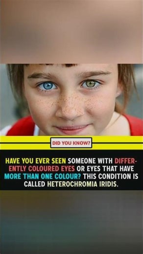Heterochromia iridis #shorts #youtubeshorts #eyecolor #beauty