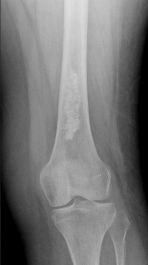 Enchondroma - femur