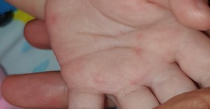 TP.HCM: Vi rút EV71 gây bệnh tay chân miệng nặng quay trở lại