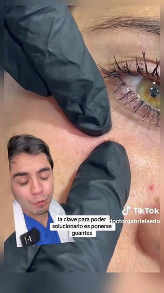 Quiste de Millium: ¿Qué es y cómo tratarlo?