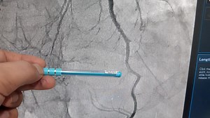 MYOCARDIAL BRIDGING IN DISTAL LAD The major coronary arteries may have a segmental intramyocardial course. During systole, this segment of the vessel is compressed, a condition referred to as "myocardial bridging.Most instances of bridging have no clinical significance. However, severe bridging of the major coronary arteries can produce myocardial ischemia, coronary thrombosis, myocardial infarction, and stress cardiomyopathyThe diagnosis of myocardial bridging is made when a section of an epica