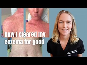 Natural Treatment for Eczema | How I Cleared My Eczema For Good