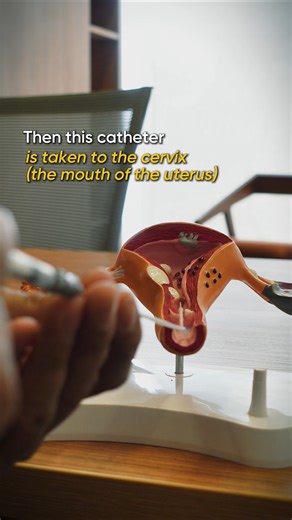 This is how we do an Embryo Transfer for pregnancy