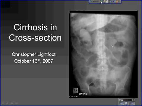 CT of liver cirrhosis - HD [Basic Radiology]