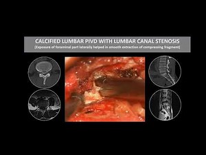 CALCIFIED LUMBAR disc Microdiscectomy| Spine surgery recovery