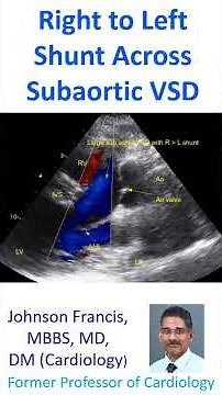 Right to left shunt across subaortic VSD