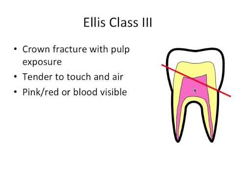 Tooth Trauma- Ellis Classification
