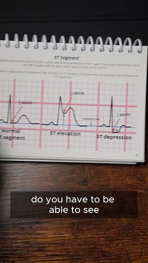 Do we need ST depression to spot a STEMI? 🤔🚑 Educational purposes only 📕 | Pocket Paramedic