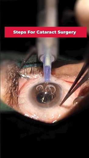 Cataract Operation Steps Explained Simply! 👁️