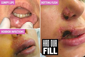 Horrific photos of fillers gone wrong - from rotting tissue to chunks of lip falling off