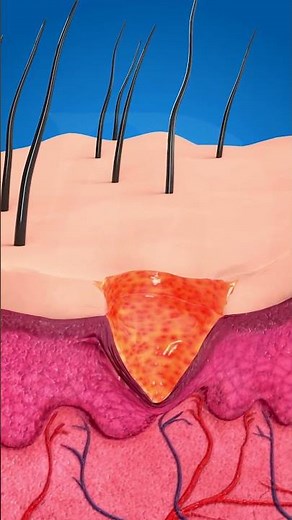 Never Rip Off Skin Tags Yourself – Safe Removal Explained