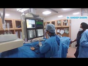 right Bronchial artery embolisation using glue