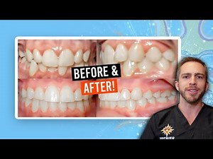Teen Braces: Crowding [BEFORE AND AFTER]