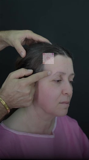 51-year-old lady | 3 months post HybridFacelift™️ Three months after surgery, the results speak for themselves—dramatic, natural, and beautifully balanced facial rejuvenation. • Procedure: HybridFacelift™️ • Anesthesia: General • Operating time: 6 hours A refreshed contour, improved jawline and neck definition, and long-lasting rejuvenation—all achieved with precision and artistry. Do you like the results? 👉 Yes or No? Write your answer in the comments. Save, share, and tag someone who is consi