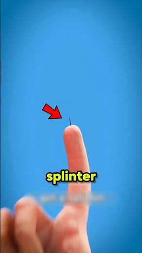 If You Ever Get a Splinter… NEVER Remove It Like This 😨