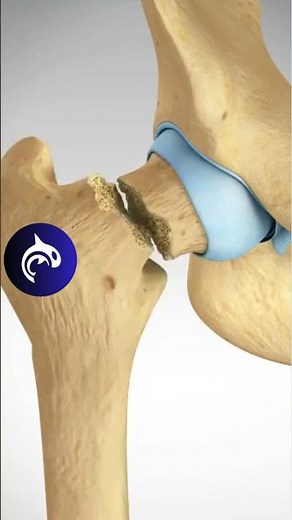 See what happens in a Femoral Neck Fracture and ORIF