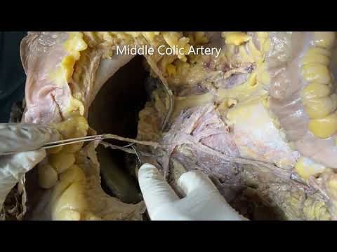 LARGE INTESTINE – Cecum Appendix Colon Sigmoid Mesentery Colic Arteries and Clinicals –Sanjoy Sanyal