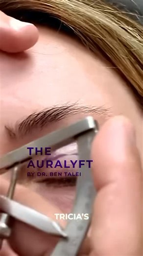 𝐁𝐞𝐧 𝐓𝐚𝐥𝐞𝐢, 𝐌𝐃 Facial plastic Surgeon | This is how the day began for Tricia and how it ended ! The complete educational video is on the @cupidcompendium website. #auralyft | Instagram
