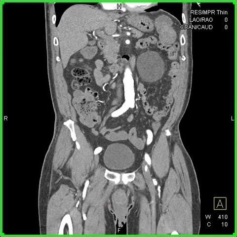 Diverticulitis with Bleed in Cecum