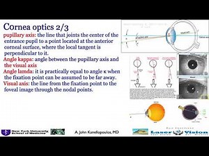 Corneal Topography Pearls: Kanellopoulos, MD