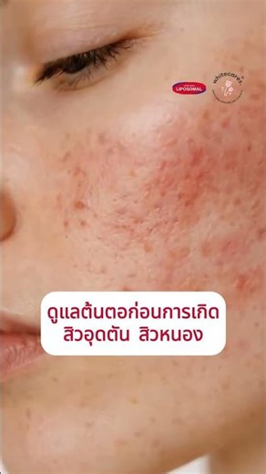 Deep Penetration Anti-Acne Lipo-Cream