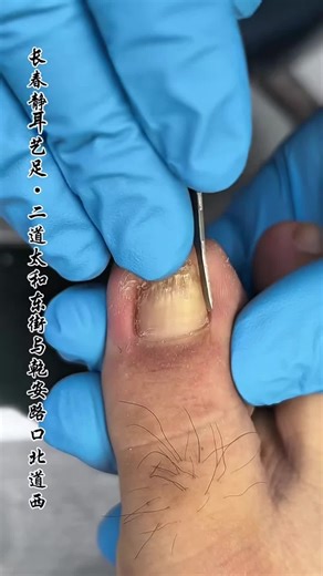Amazing Toenail Cleaning Transformation for Healthy Feet