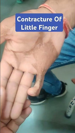 contracture of little finger after burn. #contracture #burn #handsurgery #plasticsurgery