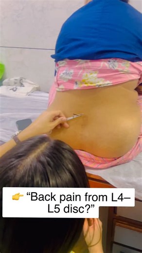 Dr Vishwa Rathi|Modern problems ke Ayurvedic Solutions on Instagram: "Lower back pain, sciatica, L4-L5 or S1 disc issues are not just muscle problems — they are nerve-related pain caused by aggravated Vata. 🔥 Agnikarma works at the root • Pacifies Vata • Reduces nerve irritation • Improves blood circulation • Gives fast relief in chronic back pain & sciatica That’s why Agnikarma is highly effective in L4-L5, S1 nerve compression and disc-related back pain. 📍 Always consult an Ayurveda doctor b