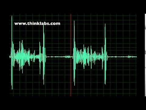 Atrial Septal Defect and Ventricular Septal Defect- normal speed