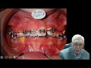 Understanding Adenoids Essential Insights for Pediatric Dentists in Orthodontic Care Case 2