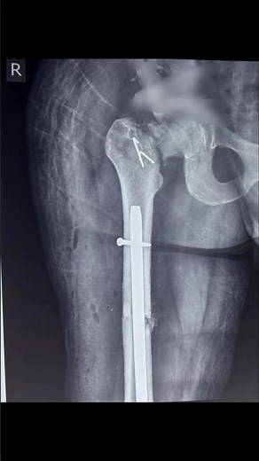 DFN - Distal Femoral Nail#subscribe #doctor #shorts