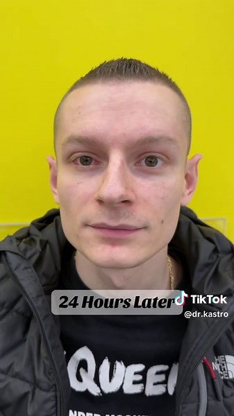 My First Day Post Strabismus Surgery Experience