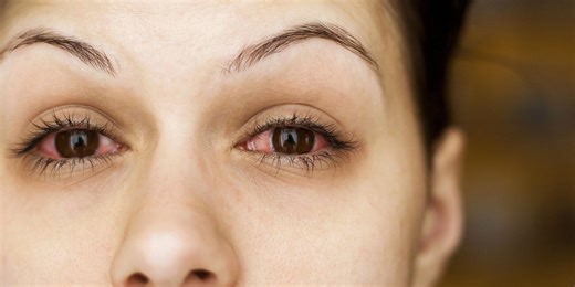 Causes and treatment of red, irritated eyes