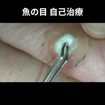 魚の目｜自己治療