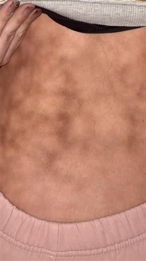 Martijn Peters on Instagram: "Oppassen met deze koude voor erythema ab igne als je veel warmtedekens of pittekussen gebruikt🔥👀"