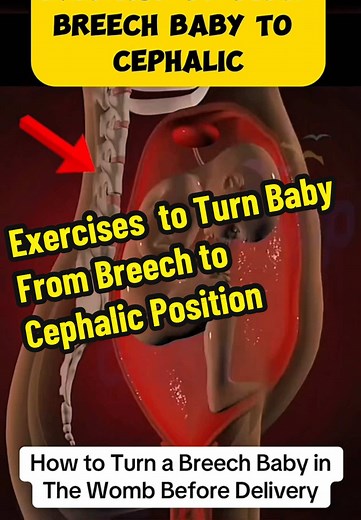 Exercises to Turn Baby From Breech to Cephalic Position