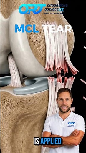 🔥 When the Knee Opens Sideways: Collateral Ligament Tear