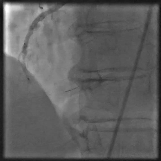 Transmural myocardial infarction