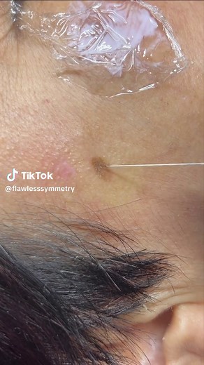 Effective Sunspot Removal with Plasma Pen Treatment