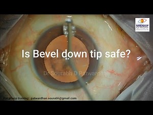 Bevel down phaco- is it safe? Dr Sourabh Patwardhan